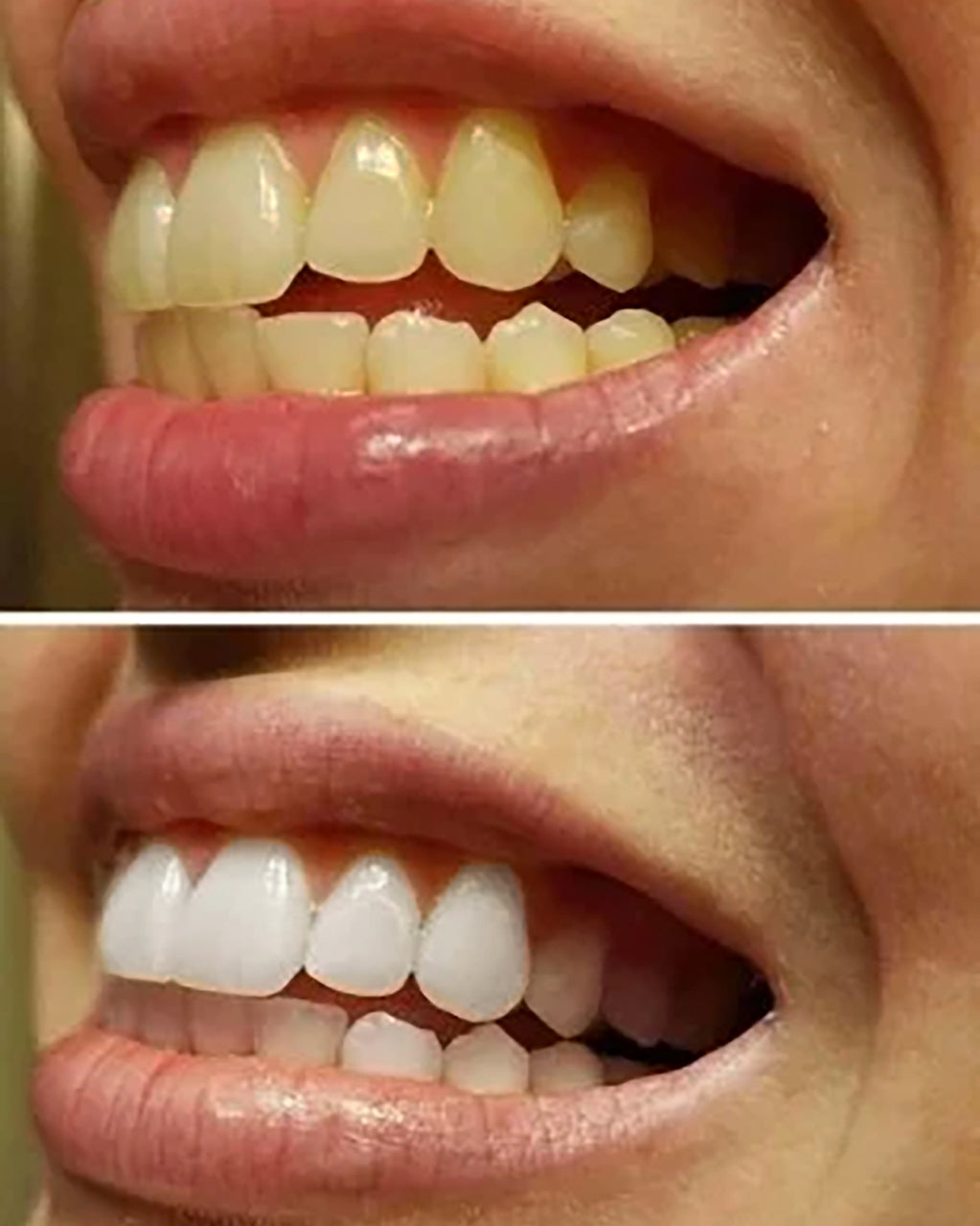Teeth Whitening Set - clicksmile.net 