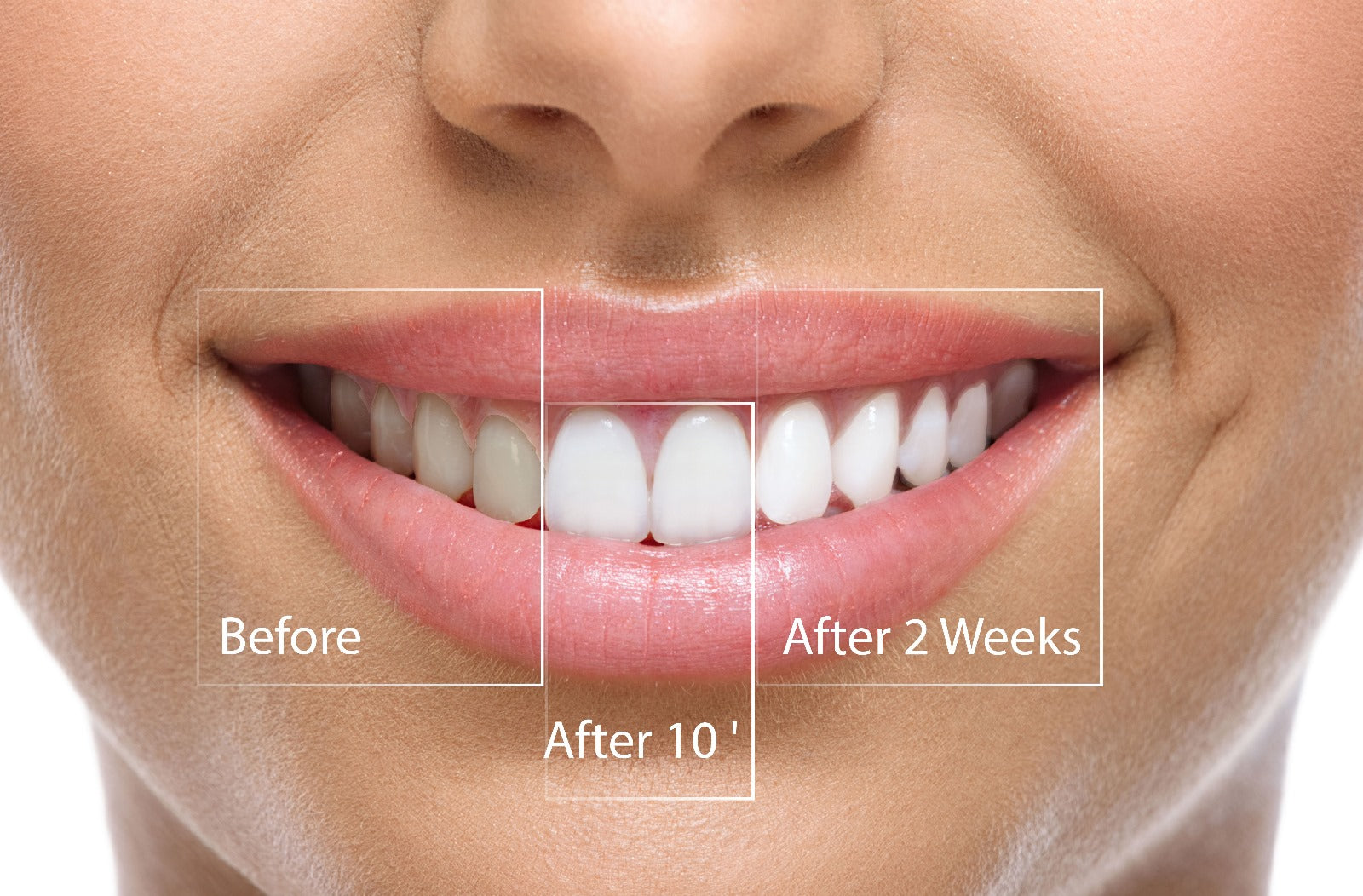 Benzi pentru Albirea dinților™ - clicksmile.net 